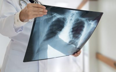 Press Release: Screening through Chest X-Rays a more accurate diagnostic tool for scores of untreated South African TB patients